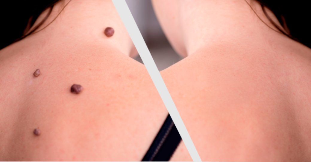 Amarose Skin Tag Remover - Help Remove Skin Moles! Price